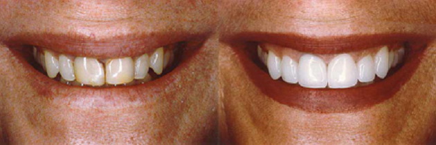 porcelain veneers two front teeth